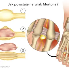 Ilustracja pokazuje powstawanie nerwiaka Mortona. Widoczne są zmiany w nerwie, które mogą prowadzić do bólu i dyskomfortu.