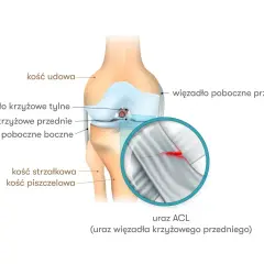 Ilustracja anatomiczna kolana z zaznaczonym naderwanym więzadłem krzyżowym przednim (ACL). Widoczne kości i inne więzadła.