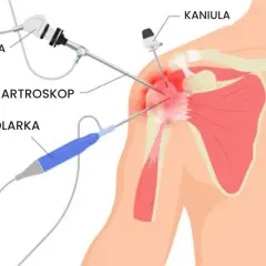 Artroskopia barku z kamerą i golarką. Po zabiegu jak długo utrzymuje się ból po artroskopii barku, zależy od wielu czynników.