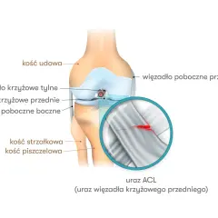 Anatomia kolana z zaznaczonym urazem ACL (więzadła krzyżowego przedniego). Powiększenie pokazuje zerwane włókna więzadła.