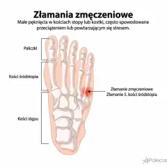 Złamanie zmęczeniowe 5. kości śródstopia, widoczne na schemacie stopy.