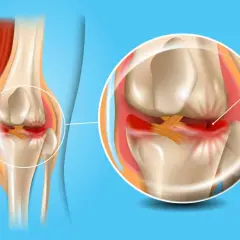 Ilustracja anatomiczna kolana z zaznaczonym uszkodzeniem łąkotki. Czerwony obszar wskazuje na stan zapalny.