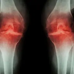 Rentgenowskie obrazy kolan, ukazujące zmiany zwyrodnieniowe. Widoczna osteotomia kolana przed i po zabiegu.