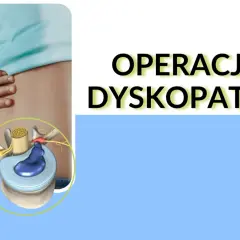 Ilustracja przedstawia dyskopatię szyjną, która może wymagać operacji. Widoczny jest krążek międzykręgowy uciskający nerw.