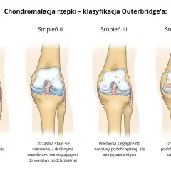 Ilustracja pokazuje cztery stopnie chondromalacji rzepki wg Outerbridge'a: od zmiękczenia chrząstki do odsłonięcia kości.
