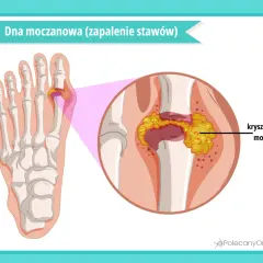 Dna moczanowa: podwyższony kwas moczowy powoduje kryształki w stawie palucha, wywołując zapalenie.