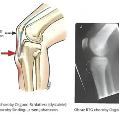 Ilustracja anatomiczna i RTG kolana pokazują lokalizację choroby Osgood-Schlattera. Unikaj nadmiernego obciążenia tej okolicy.