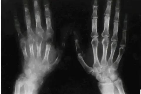 RTG dłoni ukazujący zmiany kostne charakterystyczne dla zespołu sudeckiego. Objawy widoczne jako osteoporoza, obrzęk tkanek miękkich i zmiany w stawach.