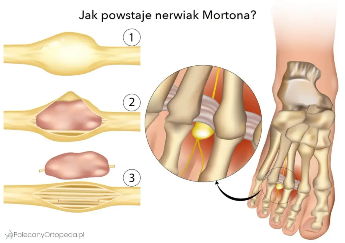 Ilustracja pokazuje powstawanie nerwiaka Mortona. Widoczne są zmiany w nerwie, które mogą prowadzić do bólu i dyskomfortu.