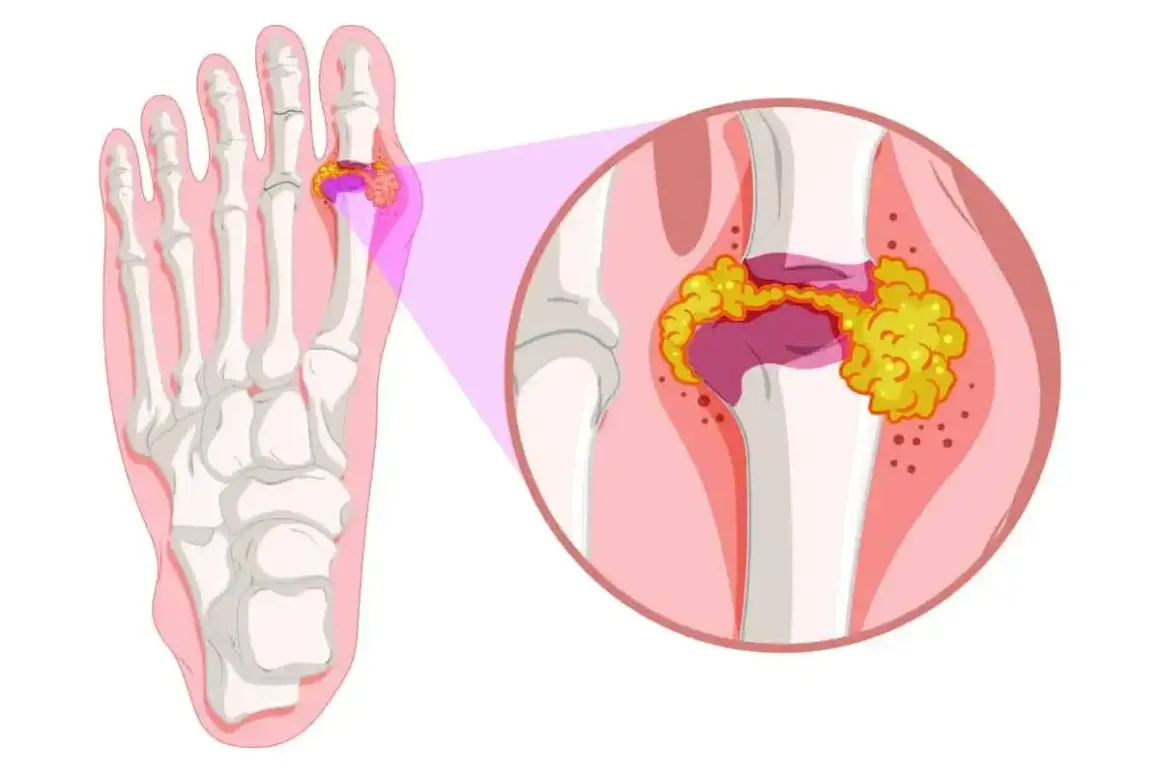 Ilustracja przedstawia zapalenie stawu śródstopno-paliczkowego palucha, z widocznym obrzękiem i kryształkami w stawie.