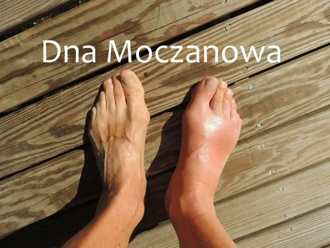 Silnie zaczerwieniony i opuchnięty paluch stopy, objaw dny moczanowej. Obok zdrowa stopa.