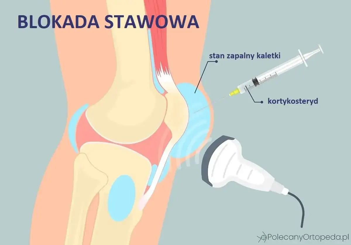 Blokada sterydowa - kiedy pomaga i na jak długo?