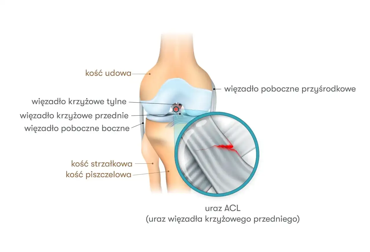 ACL w kolanie - objawy urazu i leczenie