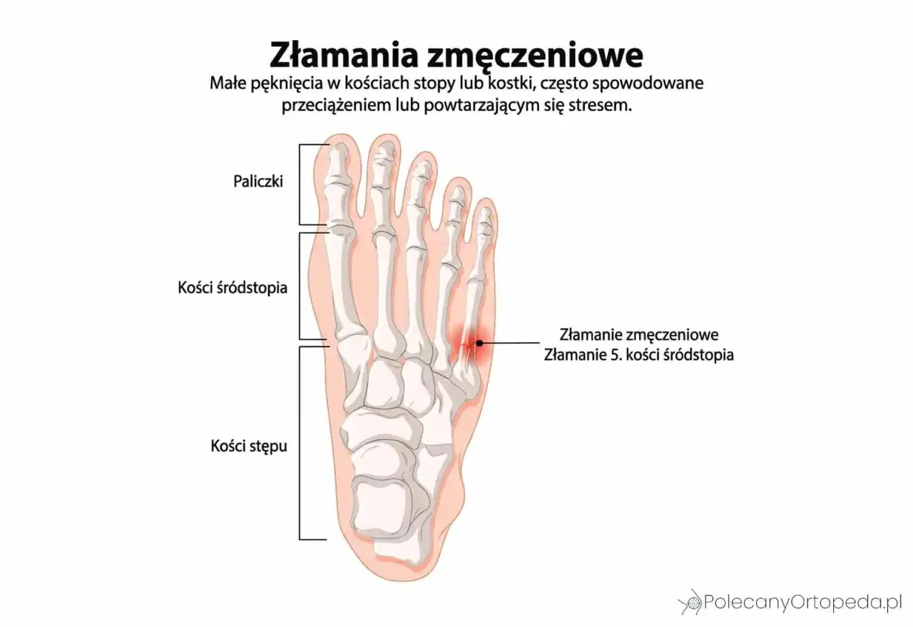 Śródstopie - budowa, ból i złamania. Kiedy do ortopedy?
