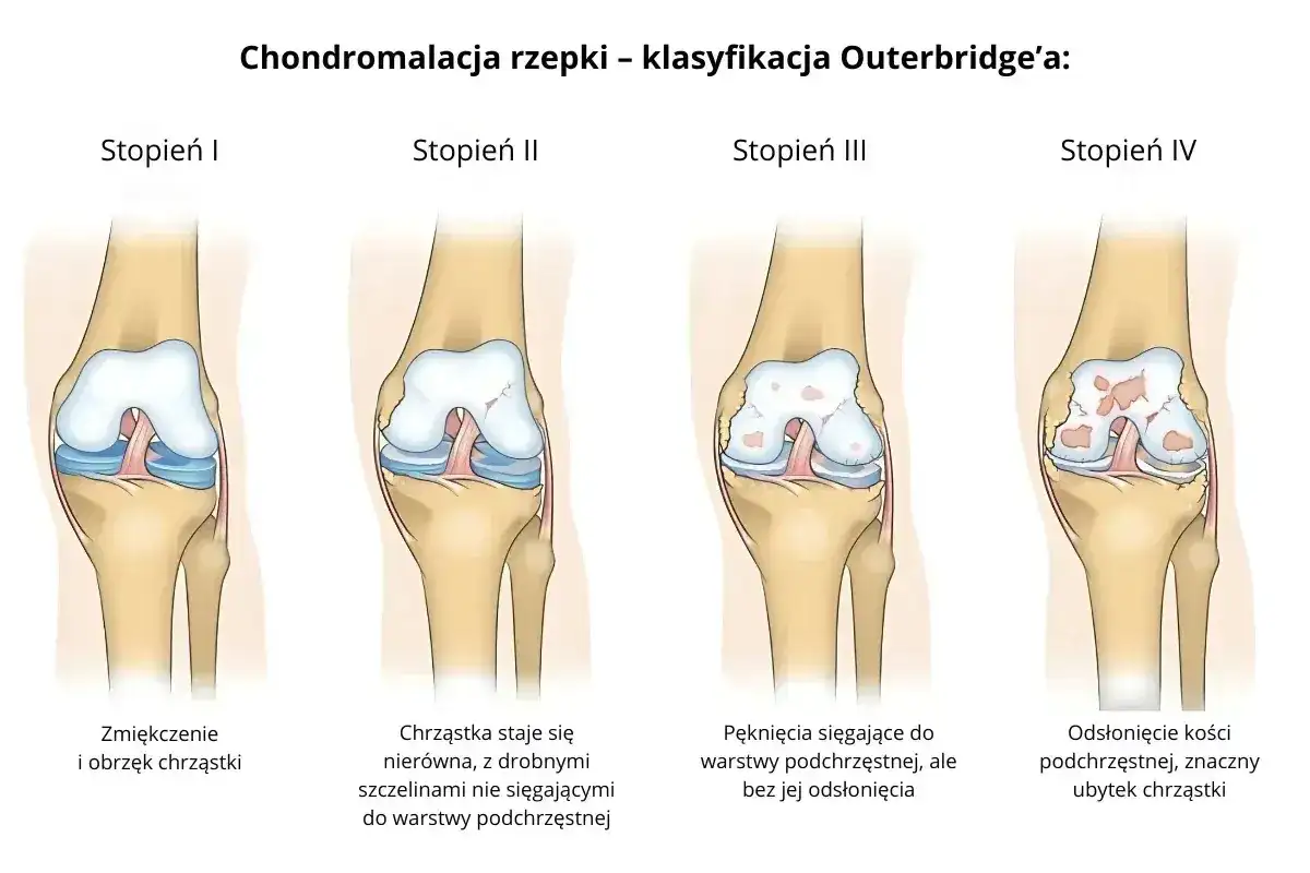 Chondromalacja kolana - objawy, diagnoza i leczenie