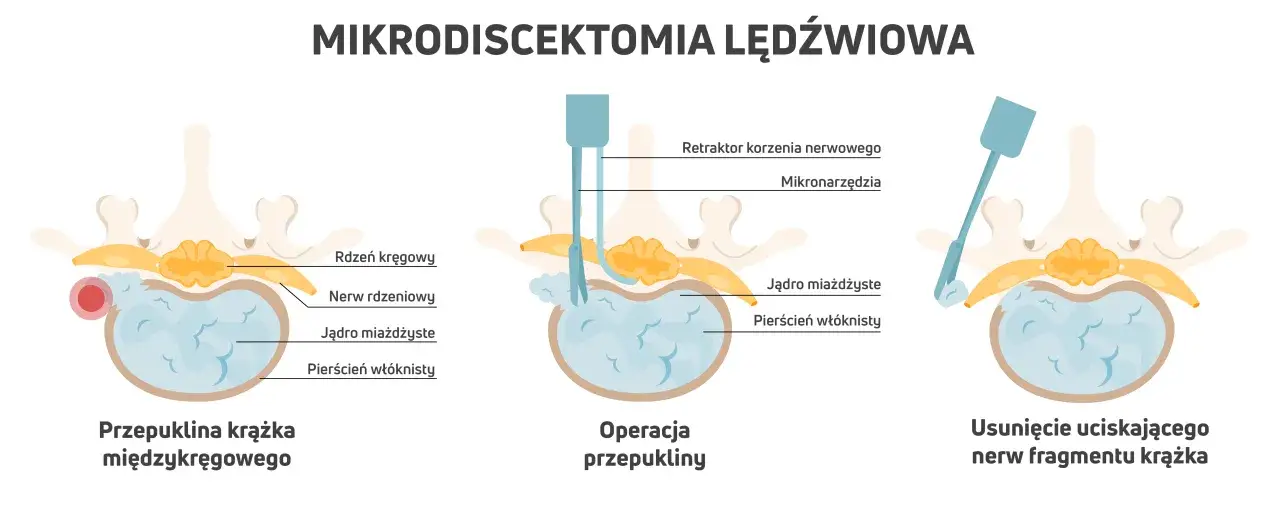 Ilustracja pokazuje etapy mikrodiscektomii lędźwiowej: przepuklinę krążka, operację z użyciem mikronarzędzi i usunięcie fragmentu krążka uciskającego nerw.