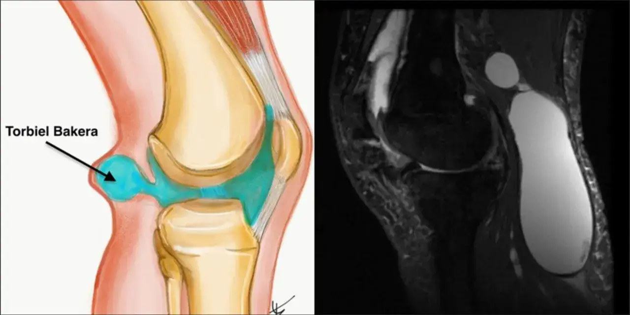 Ilustracja anatomiczna i rezonans magnetyczny kolana ukazujące torbiel okołołąkotkową, potocznie zwaną torbielą Bakera.