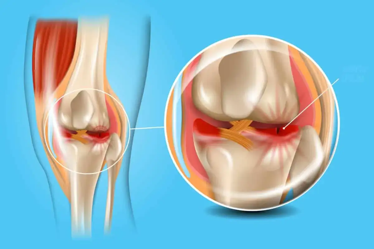Ilustracja anatomiczna kolana z zaznaczonym uszkodzeniem łąkotki. Czerwony obszar wskazuje na stan zapalny.