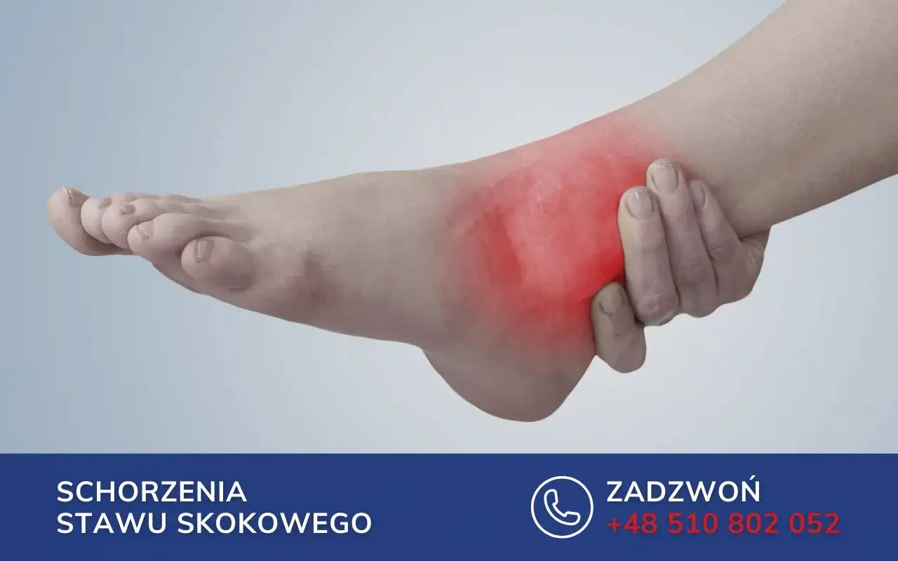 Obrzęk kostki po złamaniu może utrzymywać się długo. Czerwony obszar na stopie wskazuje na ból i stan zapalny.