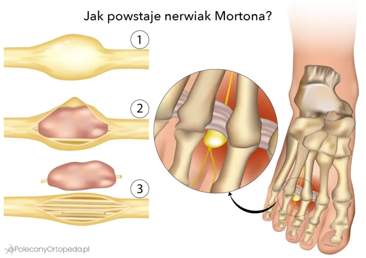 Ilustracja pokazuje powstawanie nerwiaka Mortona. Widoczne są zmiany w nerwie, które mogą prowadzić do bólu i dyskomfortu.