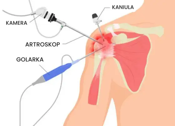 Jak długo boli bark po artroskopii? Ramy czasowe i sygnały alarmowe