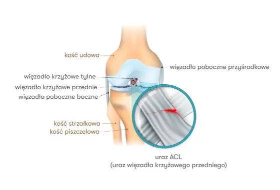 ACL w kolanie - objawy urazu i leczenie