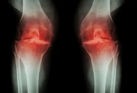 Osteotomia kolana przed i po - jak ocenić efekt zabiegu?