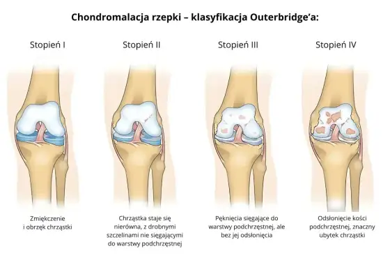Chondromalacja kolana - objawy, diagnoza i leczenie
