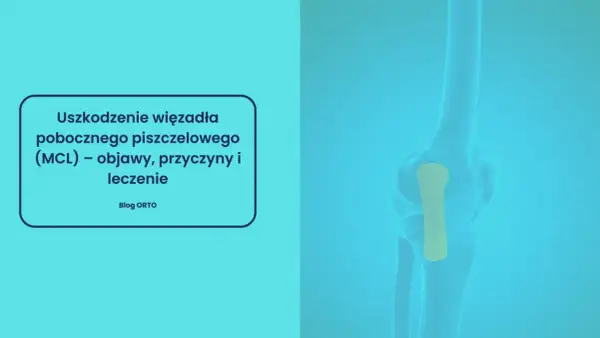 Ilustracja przedstawia uszkodzenie więzadła pobocznego piszczelowego (MCL) w stawie kolanowym.