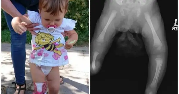 Rentgen nóżek niemowlaka z widocznym strzelaniem kości. Dziecko w pieluszce i koszulce z pszczółką Mają.