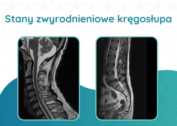 Dwa obrazy rezonansu magnetycznego kręgosłupa: szyjnego i lędźwiowego, ukazujące stany zwyrodnieniowe. Diagnostyka kręgosłupa jest kluczowa.
