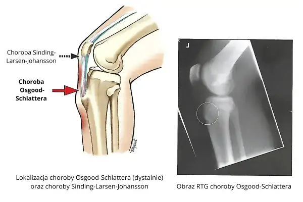 Ilustracja anatomiczna i RTG kolana pokazujące chorobę Osgooda-Schlattera, która może prowadzić do jałowej martwicy kości piszczelowej.