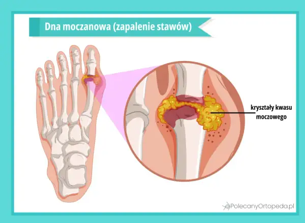 Dna moczanowa: podwyższony kwas moczowy powoduje kryształki w stawie palucha, wywołując zapalenie.