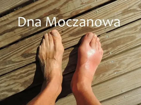 Silnie zaczerwieniony i opuchnięty paluch stopy, objaw dny moczanowej. Obok zdrowa stopa.